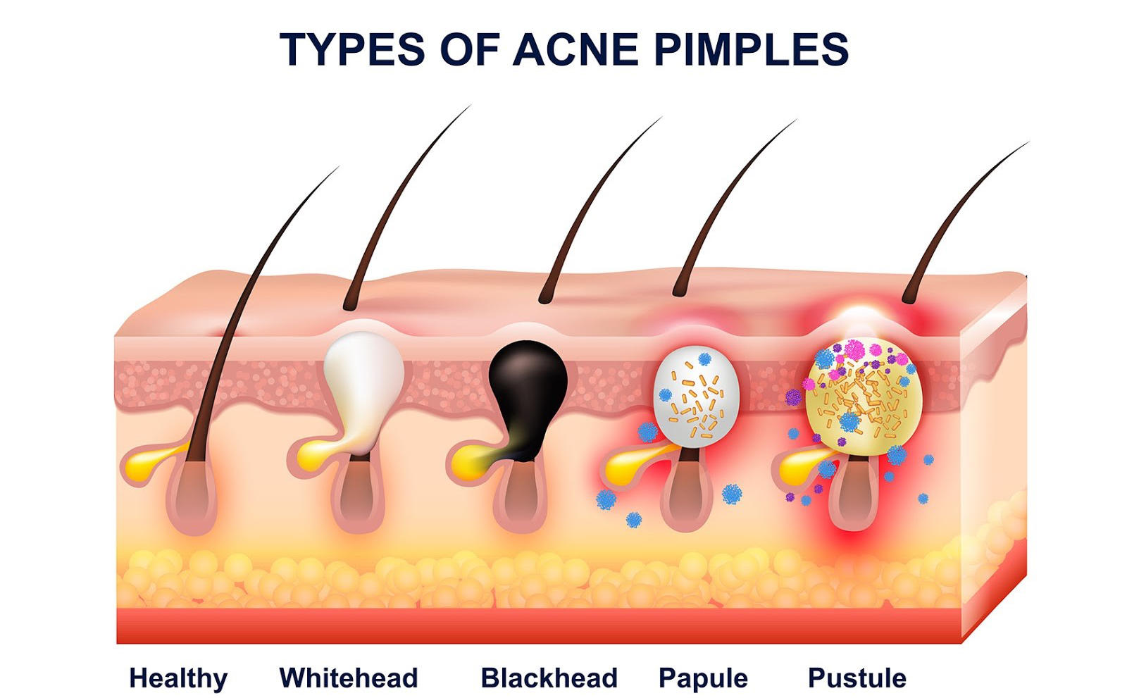 Types of Acne Pimples