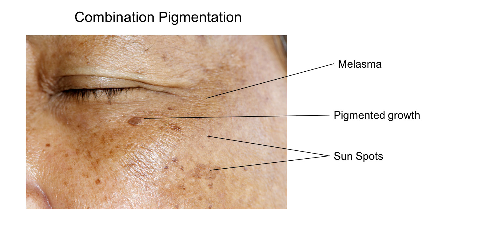 Pigments on face can be a combination of melasma, pigemented growth, sun spots