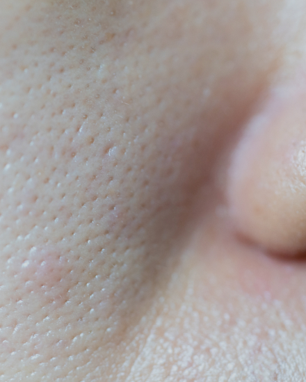 Enlarged and<br> open pores