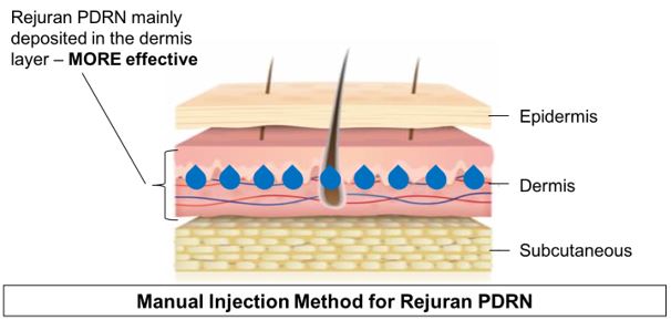 visual illustration of manual injection for rejuran pdrn